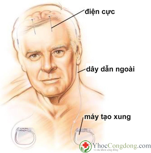 Thiết bị kích thích não sâu DBS