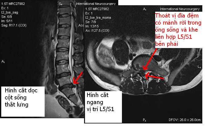 Hình chụp MRI cột sống thắt lưng của một bệnh nhân bị thoát vị đĩa đệm có mảnh rời tại tầng L5/S1 bên phải