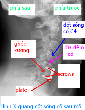 Hình X quang cột sống cổ sau phẫu thuật lấy nhân đệm tầng C5/C6 có ghép xương và có sử dụng các dụng cụ kim loại (plate and screws) làm cứng khớp đốt sống