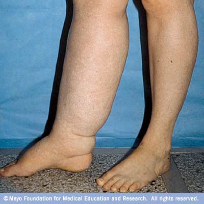 Triệu chứng phù bạch huyết ở chân