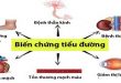 biến chứng mạn tính bệnh tiểu đường